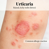 NHP Urticaria Models