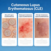 Mouse Cutaneous Lupus Erythematosus (CLE) Models