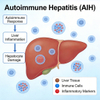 Modelle der Maus-Autoimmunhepatitis (AIH).