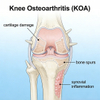 Rat Knee Osteoarthritis (KOA) Models