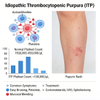 Mouse Idiopathic Thrombocytopenic Purpura (ITP) မော်ဒယ်များ