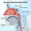 Тышқанның созылмалы риносинуситі (CRS) және аллергиялық ринит үлгілері