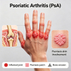 Mouse Psoriatic Arthritis (PsA) Models