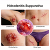 NHP Hidradenitis Suppurativa (HS) үлгілері